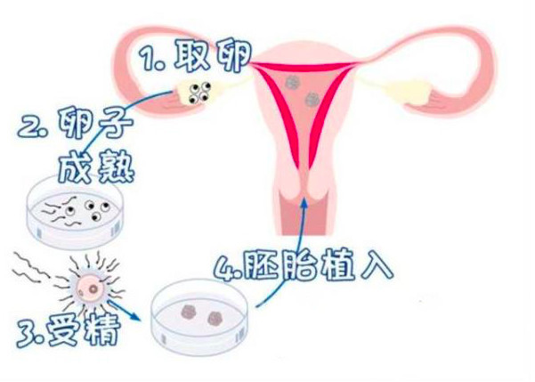 做供卵试管婴儿要卧床多久才能成功呢