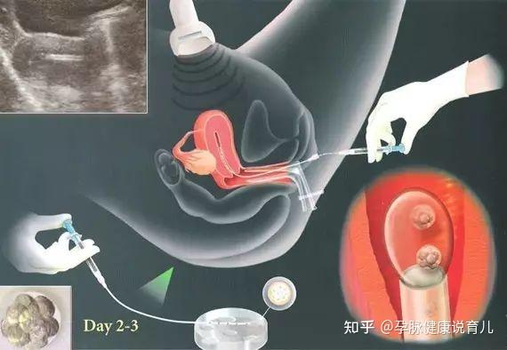 供精必须要人授三次失败才能医院代怀电话吗